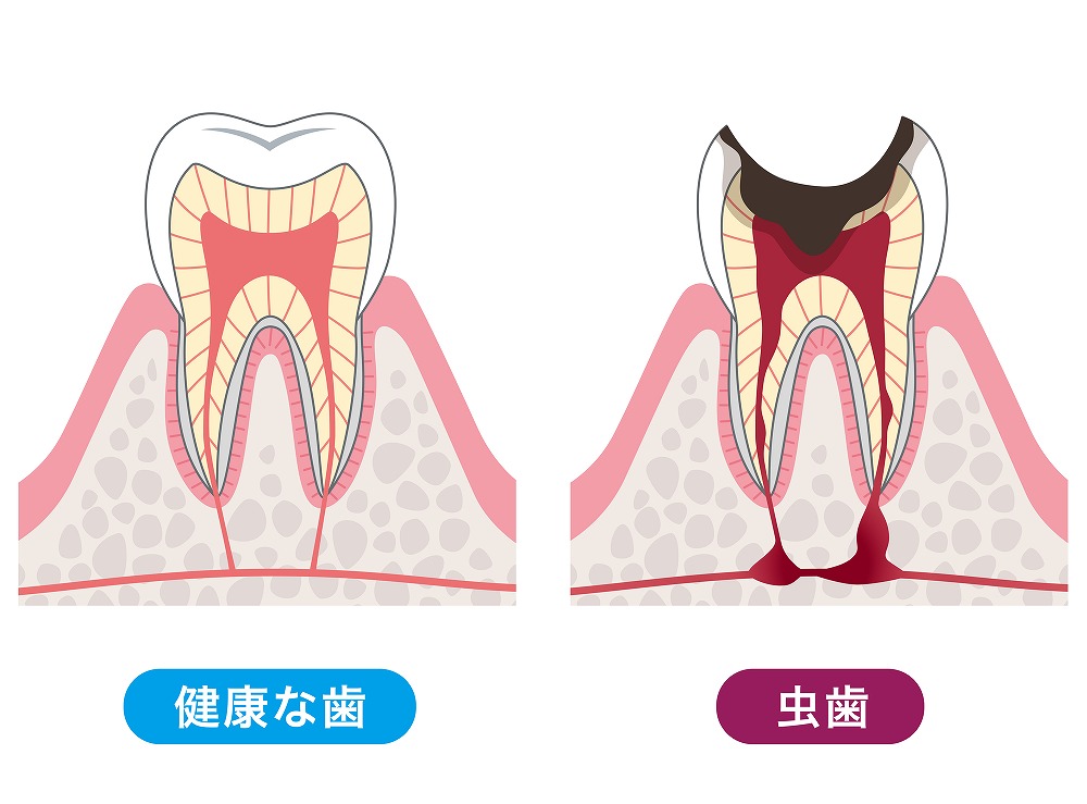 むし歯とは？