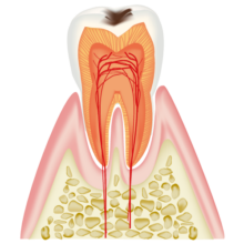 初期むし歯(C1)