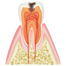 象牙質まで進行したむし歯(C2)