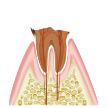 歯の根だけが残った状態(C4)