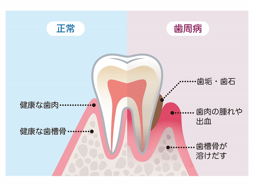 歯周病は日本人が歯を失う原因の第1位