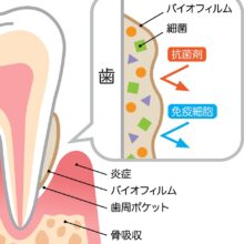 歯周病の原因