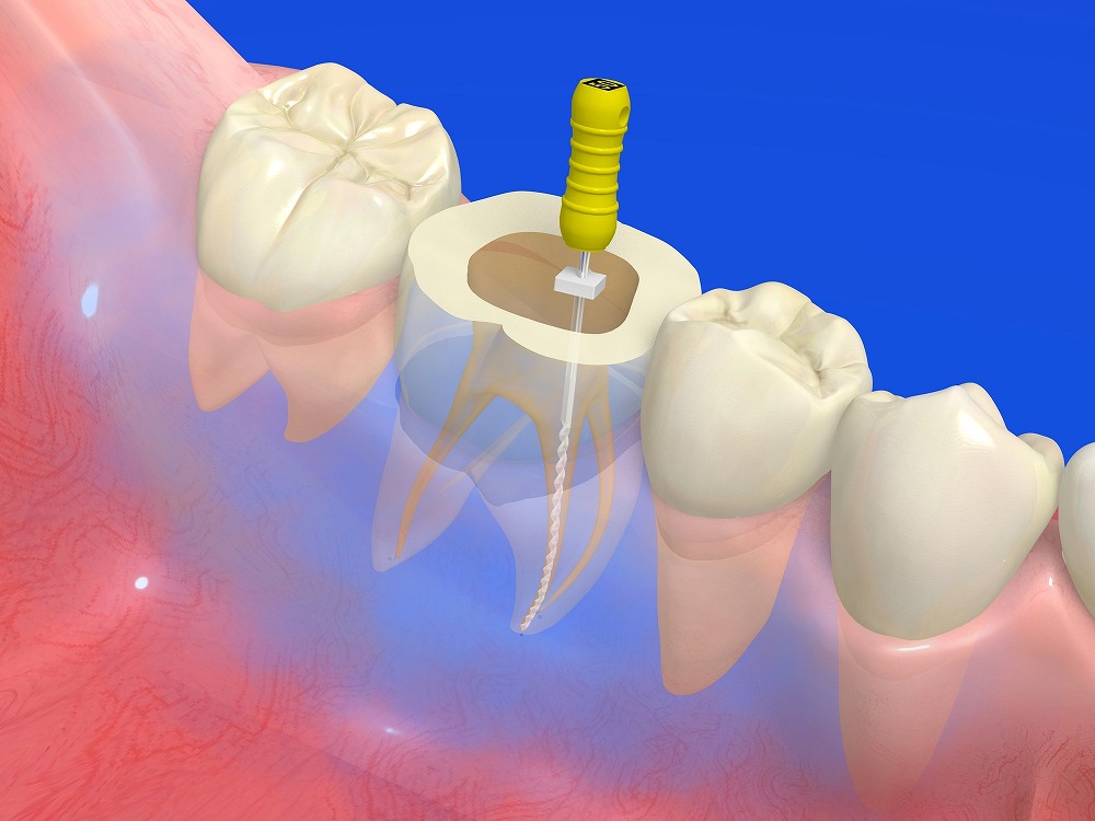 根管治療とは